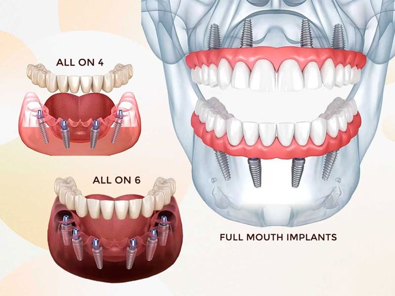 Full Mouth Rehabilitation Overview